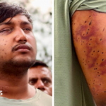 India's 'cockroach' protesters have wounds consistent with pellet-gun fire, say experts
