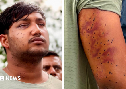 India's 'cockroach' protesters have wounds consistent with pellet-gun fire, say experts